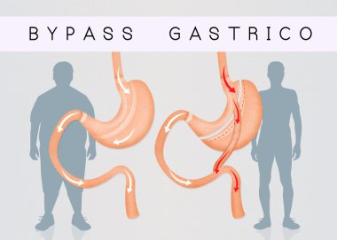 mide azaltmak için Gastrik bypass