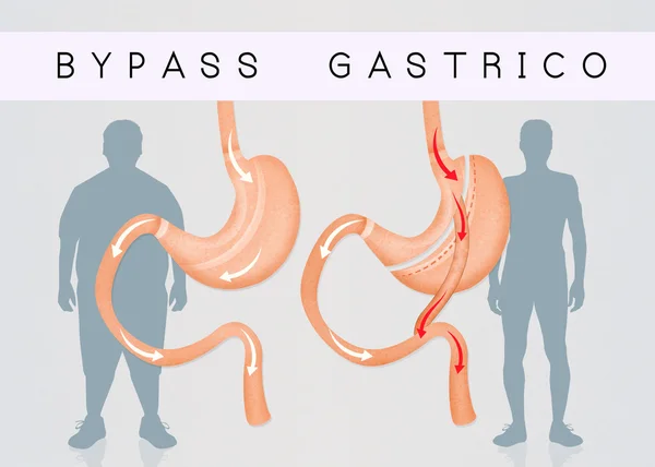 Gastric bypass to reduce stomach — Stock Photo, Image