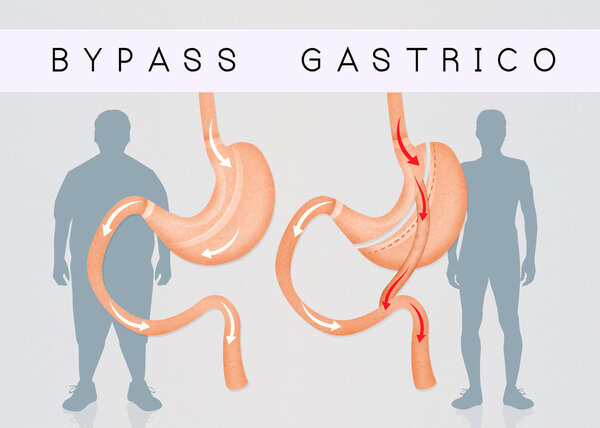 gastric bypass to reduce stomach