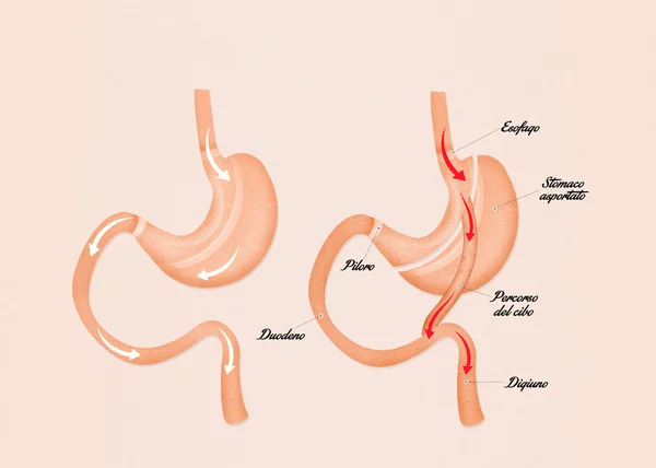 Ilustracja z żołądka bypass — Zdjęcie stockowe