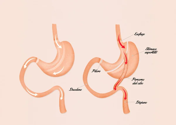 Ilustrasi dari bypass lambung — Stok Foto