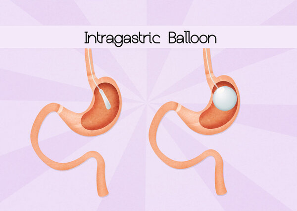 intragastric balloon surgery