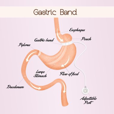 gastric band to reduce stomach clipart