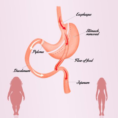 gastric bypass surgery clipart