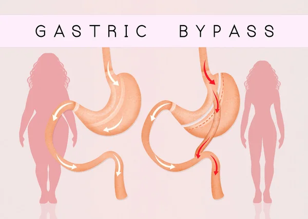 Bypass gástrico para reducir el estómago — Foto de Stock