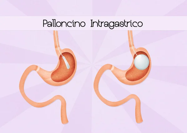 Intragastric balloon surgery — Stock Photo, Image