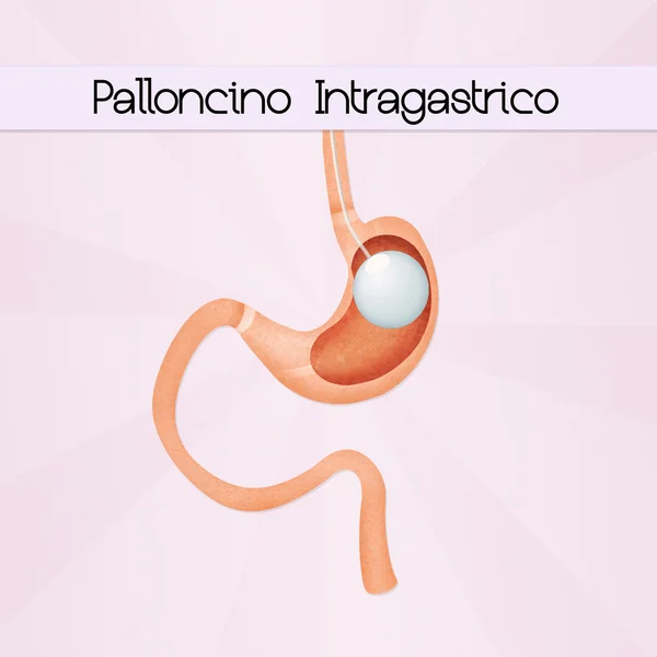 Illustration av intragastrisk ballong — Stockfoto