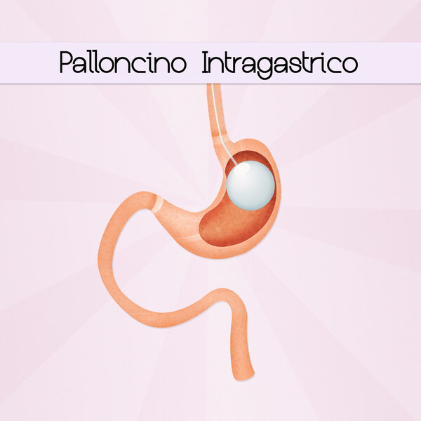 illustration of intragastric balloon