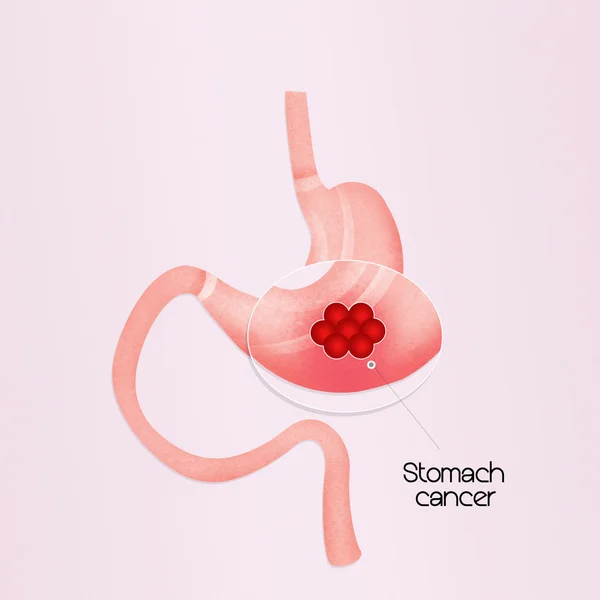 Ilustração de câncer de estômago — Fotografia de Stock