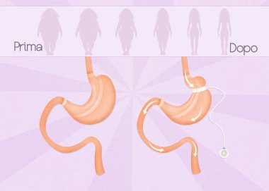 öncesi ve sonrası Gastrik band cerrahisi