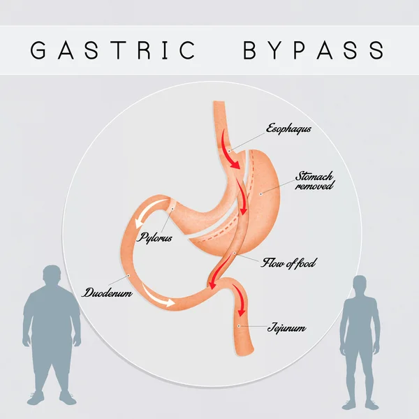 Maag-bypass chirurgie — Stockfoto