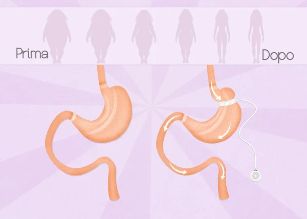Πριν και μετά από τη γαστρική χειρουργική επέμβαση μπάντα — Φωτογραφία Αρχείου