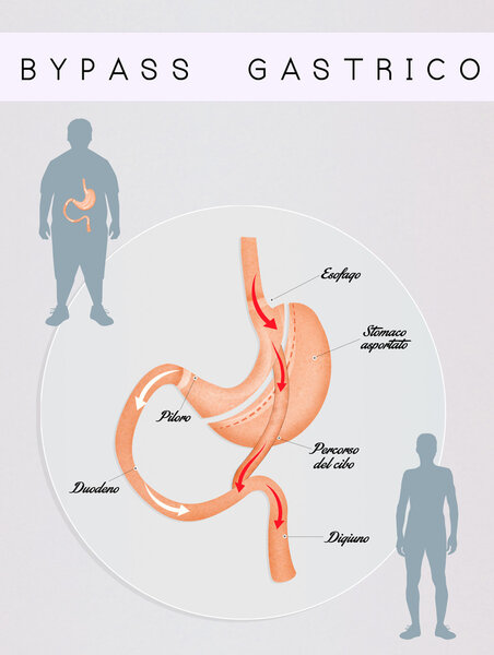 gastric bypass surgery