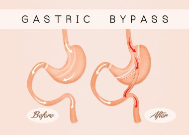 before and after gastric bypass clipart