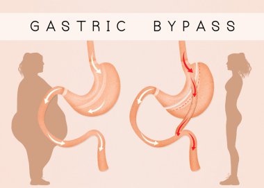 mide azaltmak için Gastrik bypass
