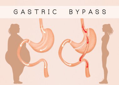 gastric bypass to reduce stomach clipart