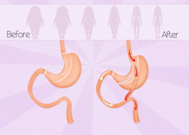 öncesi ve sonrası Gastrik bypass cerrahisi
