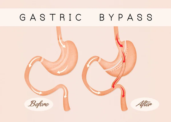 Antes y después del bypass gástrico — Foto de Stock