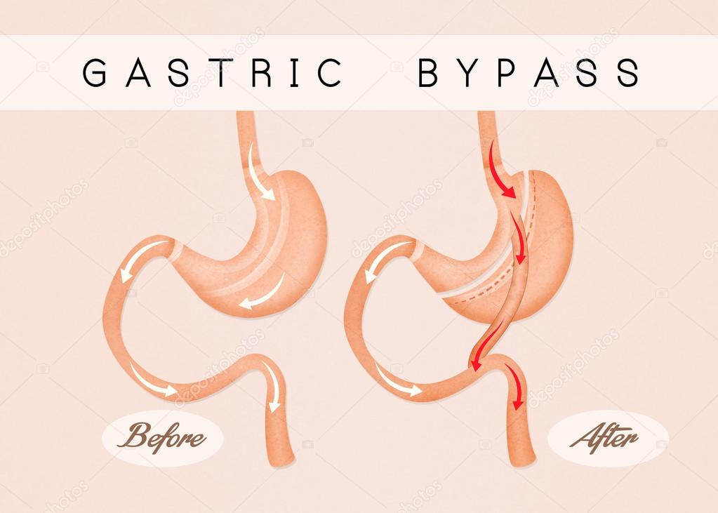 before and after gastric bypass