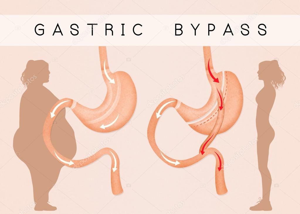 gastric bypass to reduce stomach