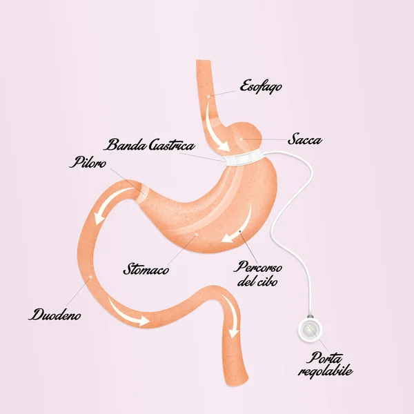 Schema di banda gastrica — Foto Stock