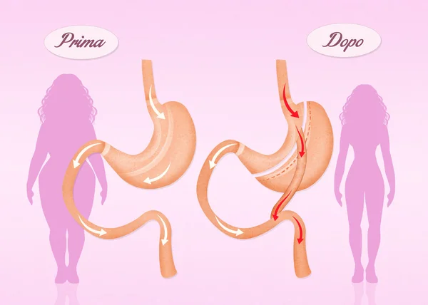 Przed i po operacji pomostowania żołądka — Zdjęcie stockowe