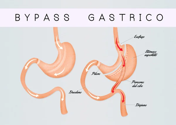 Ilustración de bypass gástrico — Foto de Stock