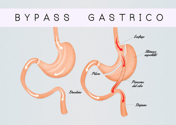 illustration of gastric bypass