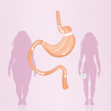 mide azaltmak için Gastrik band