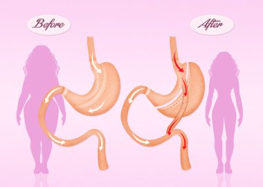 before and after gastric bypass surgery clipart