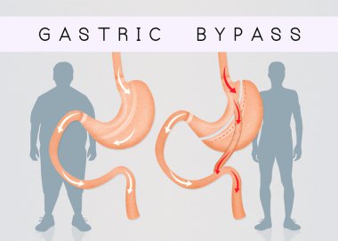 öncesi ve sonrası Gastrik bypass cerrahisi
