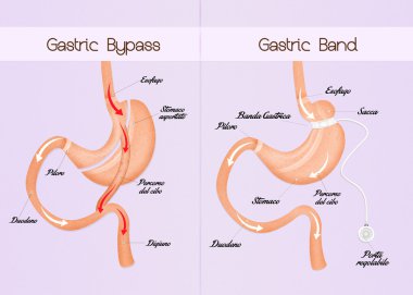 Gastrik bypass ve Gastrik band