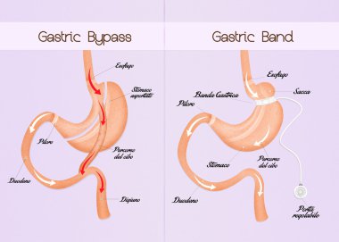gastric bypass and gastric band clipart
