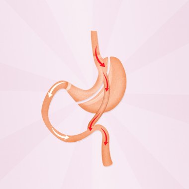 gastric bypass surgery clipart