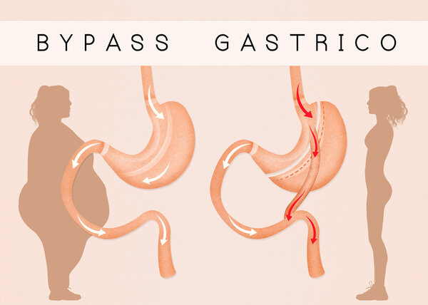 gastric bypass to reduce stomach