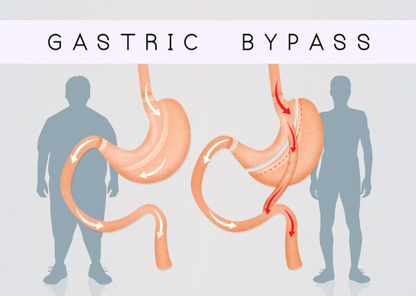 before and after gastric bypass surgery