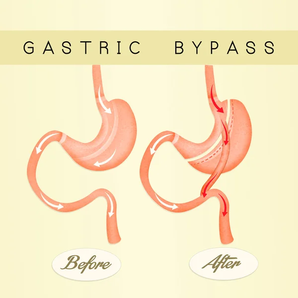 Cirurgia de bypass gástrico — Fotografia de Stock