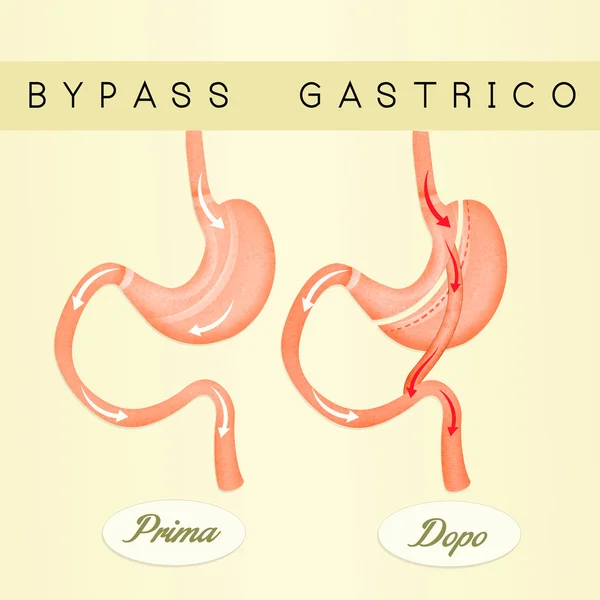 Ilustracja z żołądka bypass — Zdjęcie stockowe