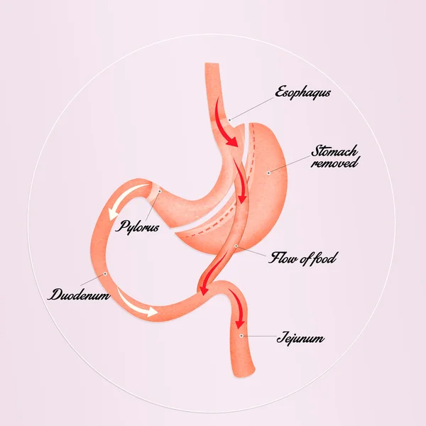 Gastrik baypas düzeni — Stok fotoğraf
