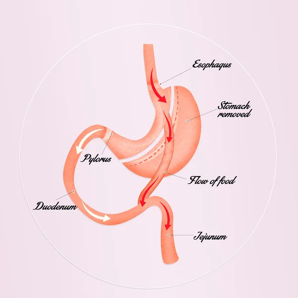 Esquema de bypass gástrico — Foto de Stock