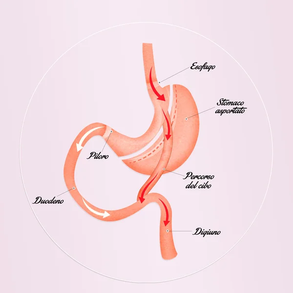 Bypass gastrico per ridurre lo stomaco — Foto Stock