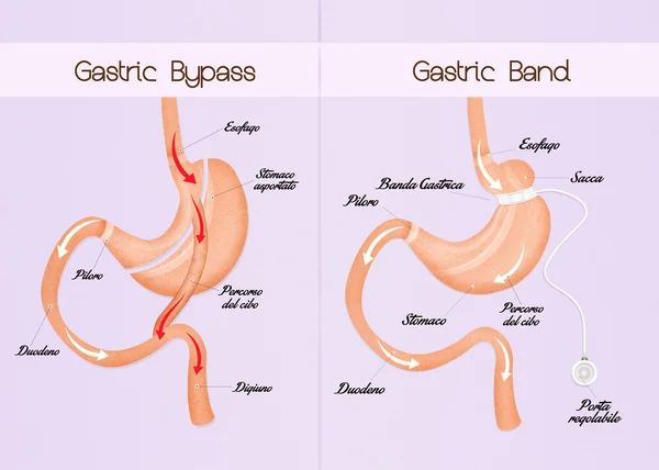 Gastric bypass and gastric band — Stock Photo, Image