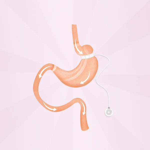 Chirurgie de bande gastrique — Photo