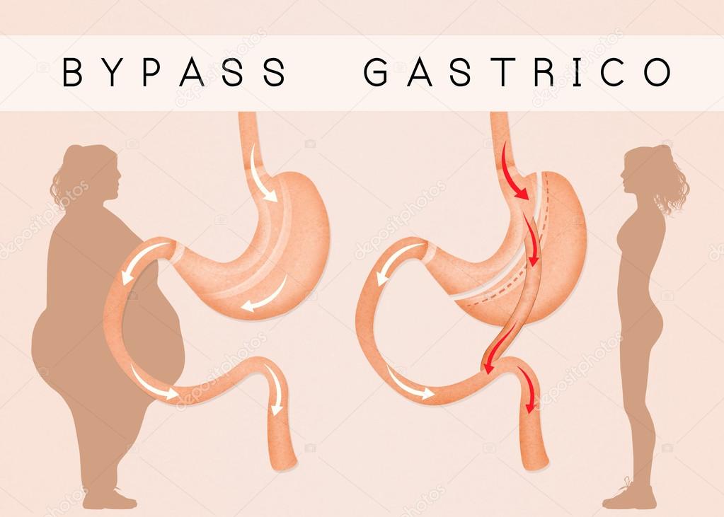 gastric bypass to reduce stomach