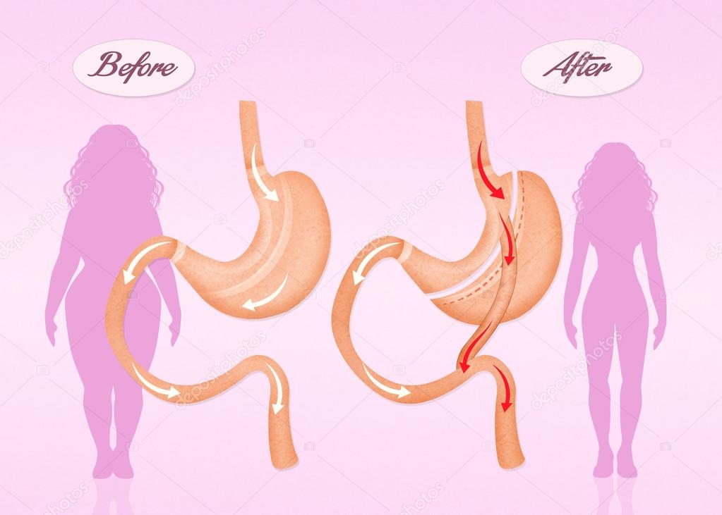 before and after gastric bypass surgery