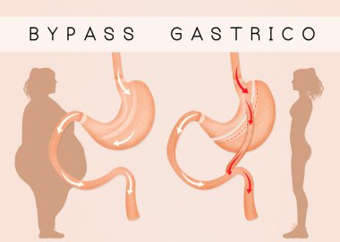 gastric bypass to reduce stomach clipart