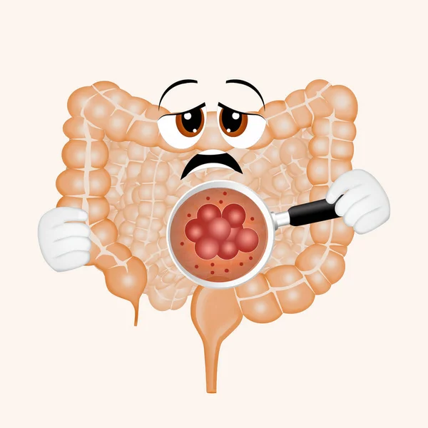 Ilustración Cáncer Intestinal — Foto de Stock