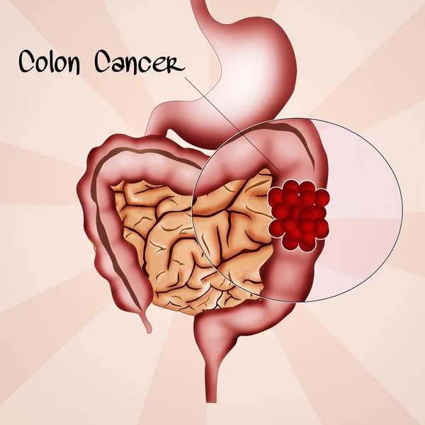 Cáncer de colon — Foto de Stock