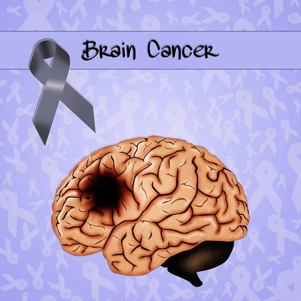 Cancer du cerveau — Photo