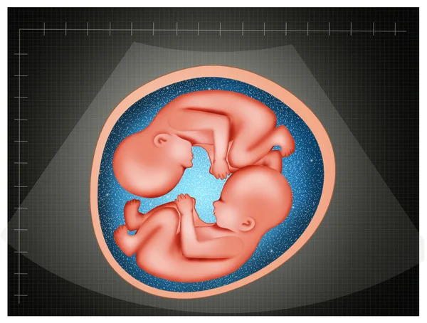 Echografie van een tweeling — Stockfoto